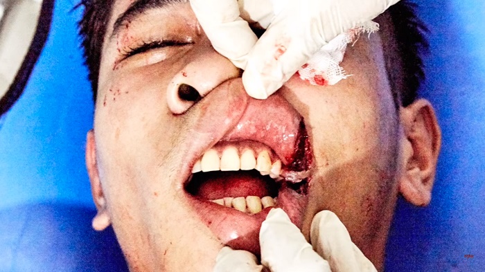 Így néz ki egy thai bokszos szájműtét (videó)