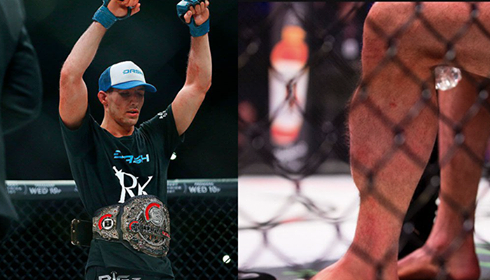 Horrorsérülten lett a Bellator váltósúlyú bajnoka Rory MacDonald