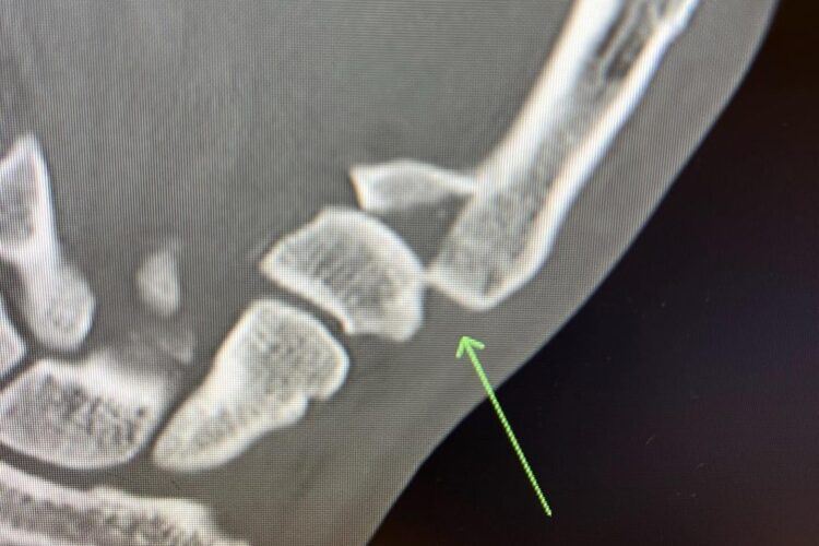 Alexander Volkanovski a második menetben eltörte a hüvelykujját Max Holloway ellen